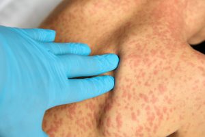 Measles ജാഗ്രതാ നിർദ്ദേശം; ക്രിസ്മസ് കാലയളവിൽ കരുതിയിരിക്കണം