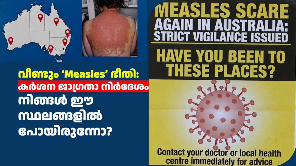 വീണ്ടും ‘Measles’ ഭീതി: കർശന ജാഗ്രതാ നിർദേശം; നിങ്ങൾ ഈ സ്ഥലങ്ങളിൽ പോയിരുന്നോ?