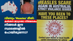 വീണ്ടും ‘Measles’ ഭീതി: കർശന ജാഗ്രതാ നിർദേശം; നിങ്ങൾ ഈ സ്ഥലങ്ങളിൽ പോയിരുന്നോ?