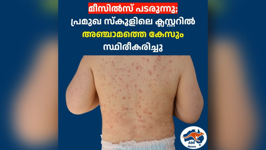 അഡ്‌ലെയ്ഡിൽ മീസിൽസ് പടരുന്നു; പ്രമുഖ സ്കൂളിലെ ക്ലസ്റ്ററിൽ അഞ്ചാമത്തെ കേസും സ്ഥിരീകരിച്ചു